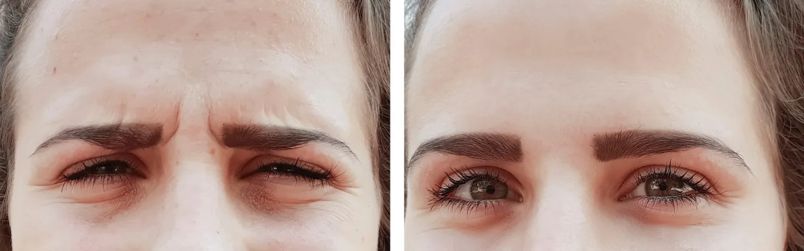 woman squinting after receiving botox