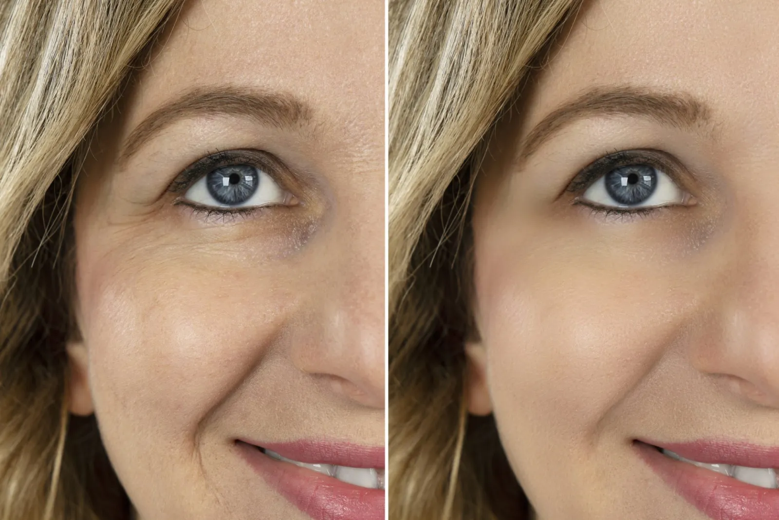older women Botox areas