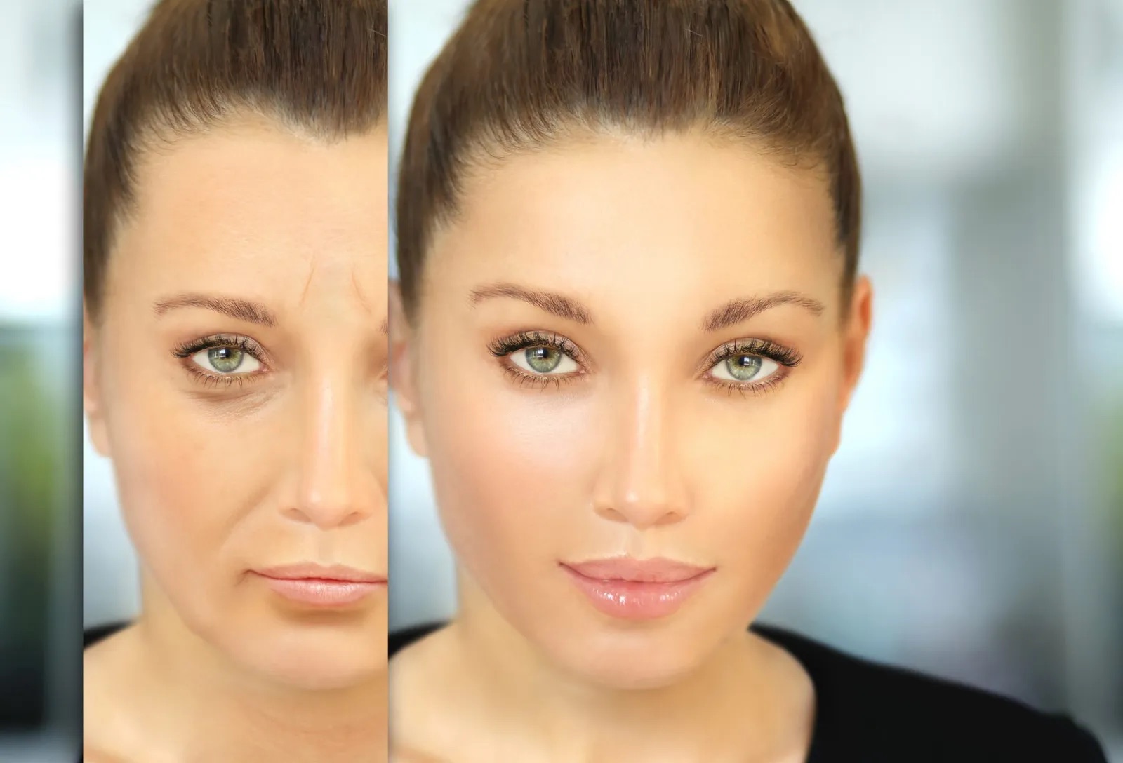 Dermal Fillers for Nasolabial Folds in Scottsdale, AZ: Cost, Results