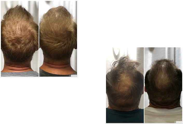 hair-thearpy