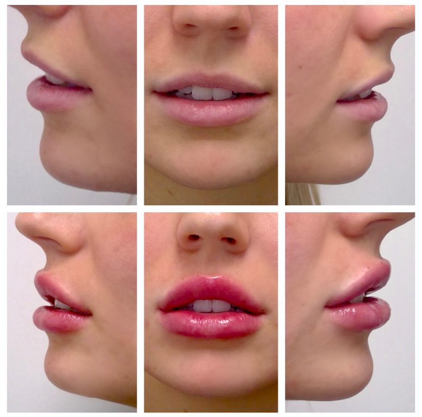 8 Different Types Of Lip Filler Shapes - Westlake Dermatology