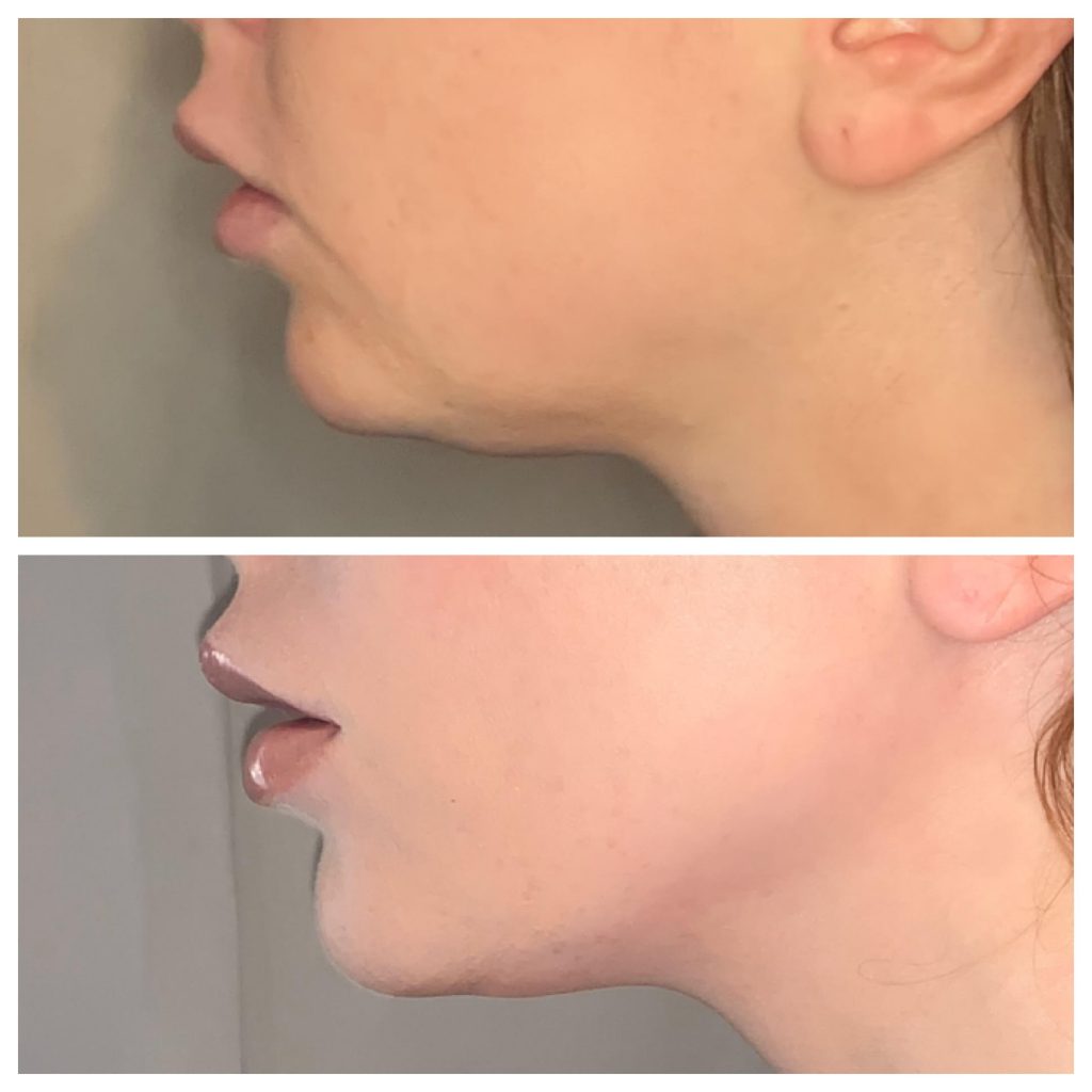 Kybella Injections Before & After Photos